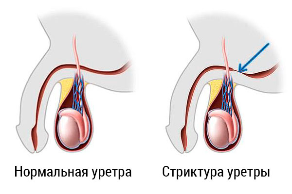 Уретра У Женщин Фото